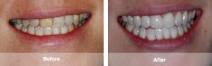 1 Front Upper Veneer and Zoom Whitening