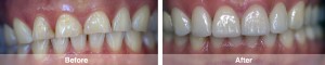 Full Upper Veneers 2